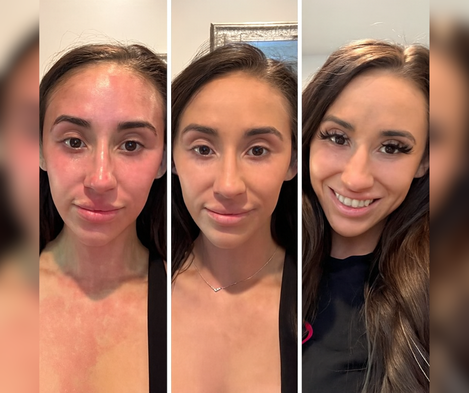 Patient progress photos showing skin renewal over multiple stages