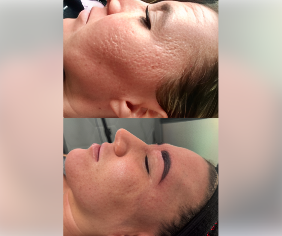 Patient before and after treatment showing improved skin texture and tone